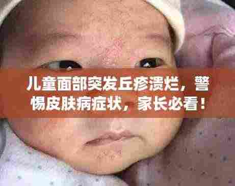 儿童面部突发丘疹溃烂,警惕皮肤病症状,家长必看!